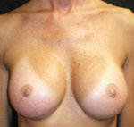 Breast Augmentation After Photo Case 4