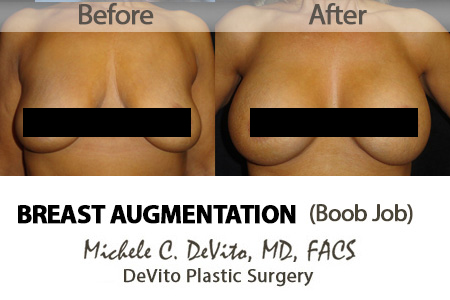 Best Boob Job (Breast Augmentation) in Scottsdale & Phoenix