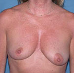 Scottsdale Breast Lift Before Photos Case 1