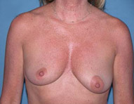 Scottsdale Breast Lift Before Photos Case 1