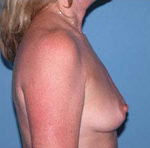 Scottsdale Breast Lift Before Photos Case 1