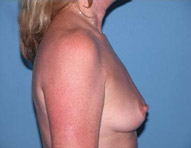 Scottsdale Breast Lift Before Photos Case 1