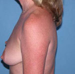 Scottsdale Breast Lift Before Photos Case 1
