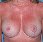 Scottsdale Breast Lift After Photos Case 1