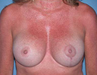 Scottsdale Breast Lift After Photos Case 1