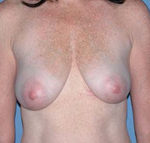 Arizona Breast Lift Before Photos Case 2