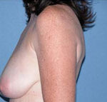 Arizona Breast Lift Before Photos Case 2