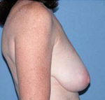 Arizona Breast Lift Before Photos Case 2