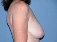 Arizona Breast Lift Before Photos Case 2