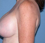 Arizona Breast Lift After Photos Case 2