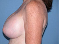 Arizona Breast Lift After Photos Case 2