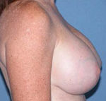 Arizona Breast Lift After Photos Case 2