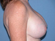 Arizona Breast Lift After Photos Case 2