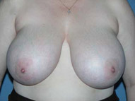 Breast Reduction Scottsdale Arizona Before Photos Case 1