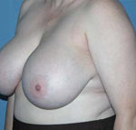 Breast Reduction Scottsdale Arizona Before Photos Case 1