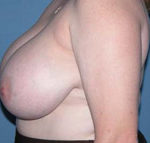 Breast Reduction Scottsdale Arizona Before Photos Case 1