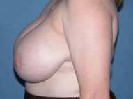 Breast Reduction Scottsdale Arizona Before Photos Case 1