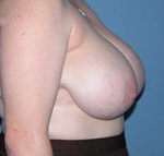 Breast Reduction Scottsdale Arizona Before Photos Case 1