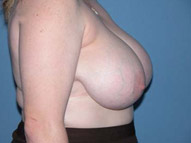 Breast Reduction Scottsdale Arizona Before Photos Case 1