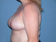 Breast Reduction Scottsdale Arizona After Photos Case 1