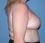 Breast Reduction Scottsdale Arizona After Photos Case 1