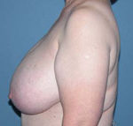 Scottsdale Breast Reduction Before Photos Case 2