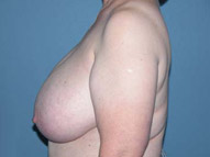 Scottsdale Breast Reduction Before Photos Case 2
