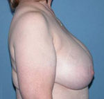 Scottsdale Breast Reduction Before Photos Case 2