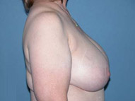 Scottsdale Breast Reduction Before Photos Case 2