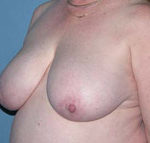 Breast Reduction Phoenix & Scottsdale Before Photos Case 3