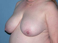 Breast Reduction Phoenix & Scottsdale Before Photos Case 3