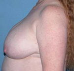 Breast Reduction Phoenix & Scottsdale Before Photos Case 3