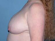 Breast Reduction Phoenix & Scottsdale Before Photos Case 3