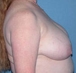 Breast Reduction Phoenix & Scottsdale Before Photos Case 3