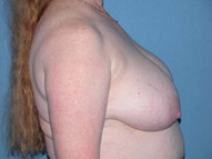 Breast Reduction Phoenix & Scottsdale Before Photos Case 3