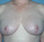 Breast Reduction Phoenix & Scottsdale After Photos Case 3