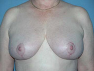 Breast Reduction Phoenix & Scottsdale After Photos Case 3