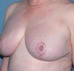 Breast Reduction Phoenix & Scottsdale After Photos Case 3
