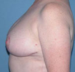 Breast Reduction Phoenix & Scottsdale After Photos Case 3