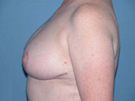 Breast Reduction Phoenix & Scottsdale After Photos Case 3