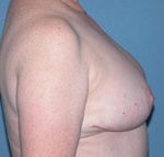 Breast Reduction Phoenix & Scottsdale After Photos Case 3