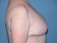 Breast Reduction Phoenix & Scottsdale After Photos Case 3