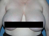 Best Breast Reduction in Scottsdale & Phoenix