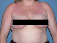 Best Breast Reduction in Scottsdale & Phoenix