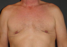 After Gynecomastia Surgery