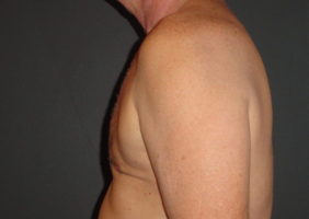 After Gynecomastia Surgery