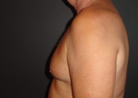 Before Gynecomastia Surgery