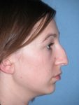 Rhinoplasty Before And After Photos Case 1