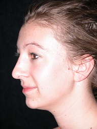 Rhinoplasty Before And After Photos Case 1