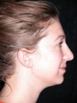 Rhinoplasty Before And After Photos Case 1